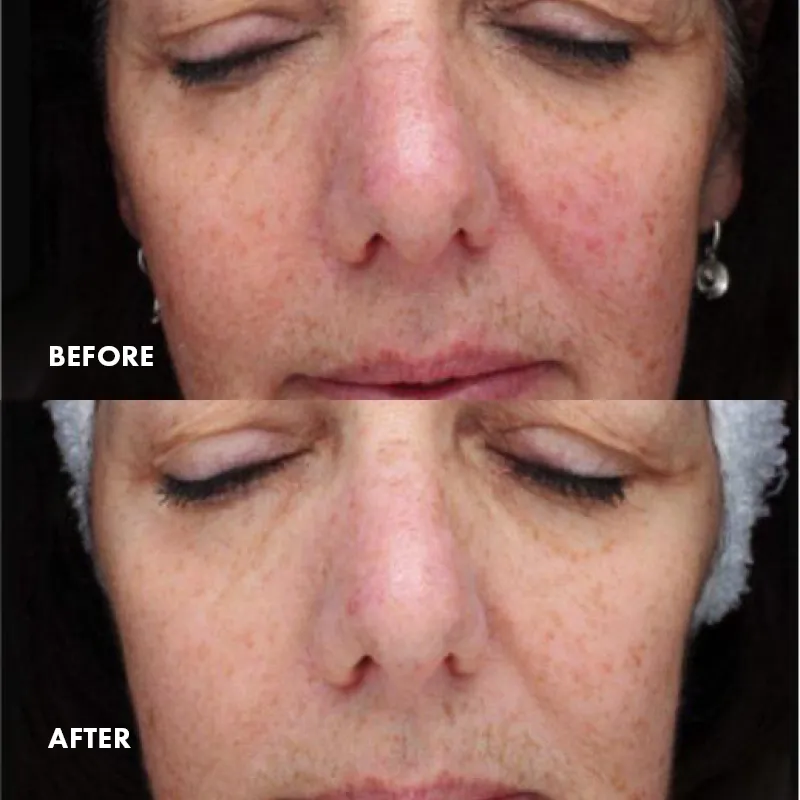 Omnilux Contour FACE